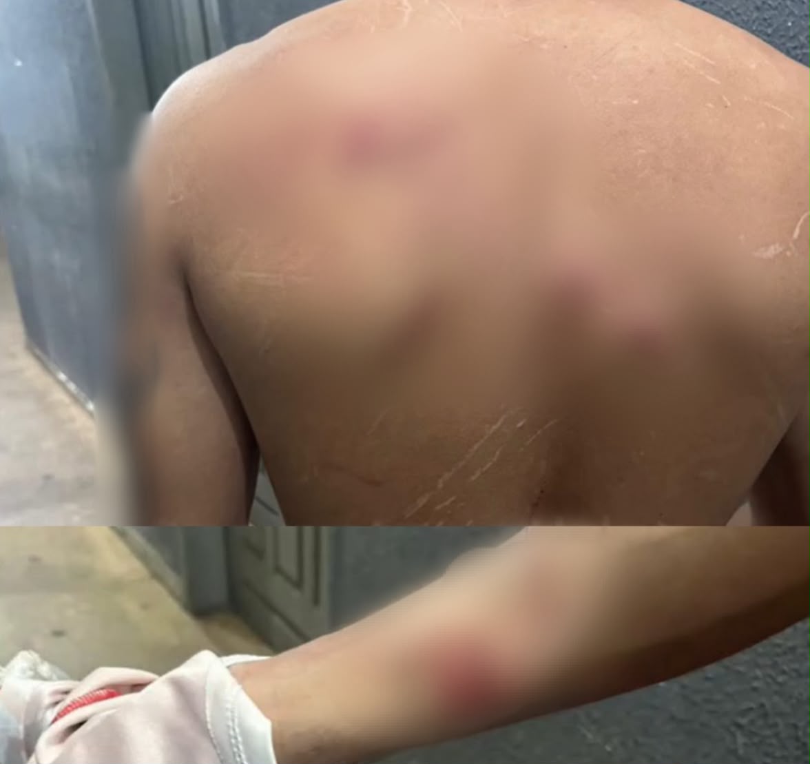 Pai fica ferido ao proteger bebê de 16 dias durante surto de violência doméstica em Imperatriz
