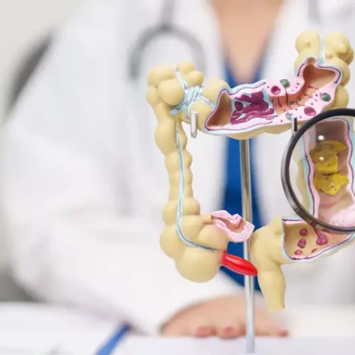 SUS anuncia exame gratuito para ampliar prevenção ao câncer de intestino no Brasil